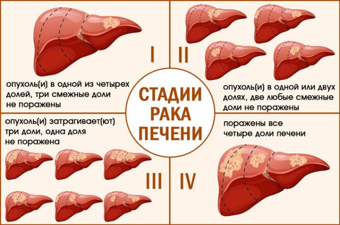 Симптомы рака печени. Стадии заболевания печени.