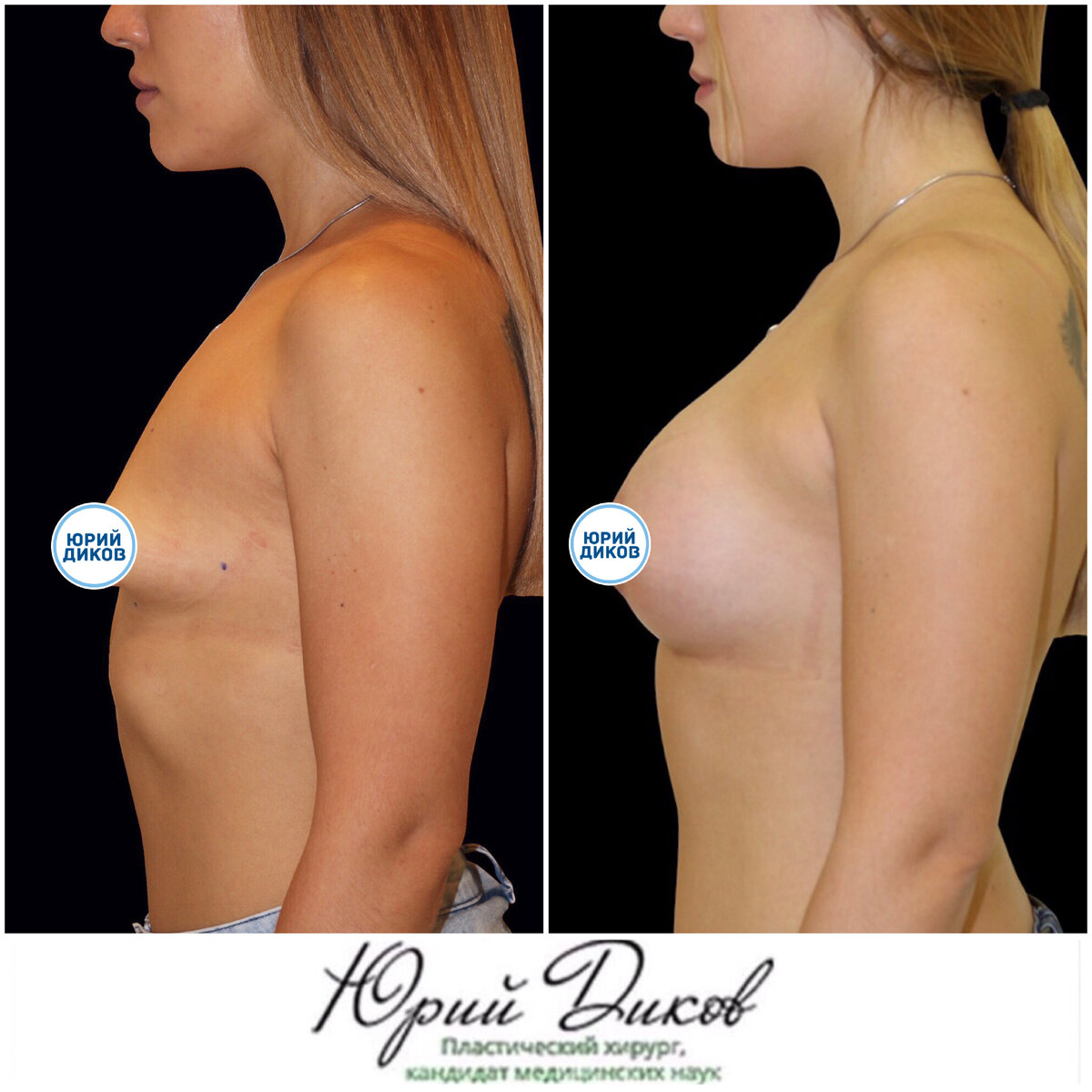 тубулярная деформация груди у женщин фото 22