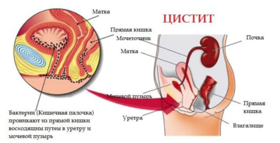 Увеличение матки перед месячными