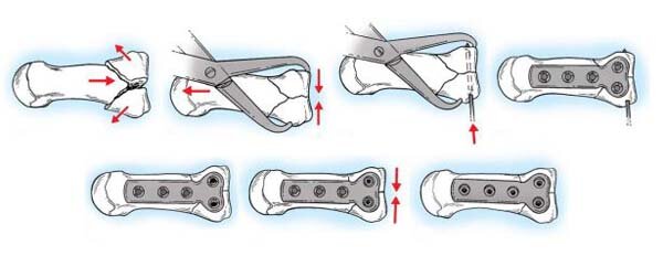 Как устанавливаются пластины при переломах
