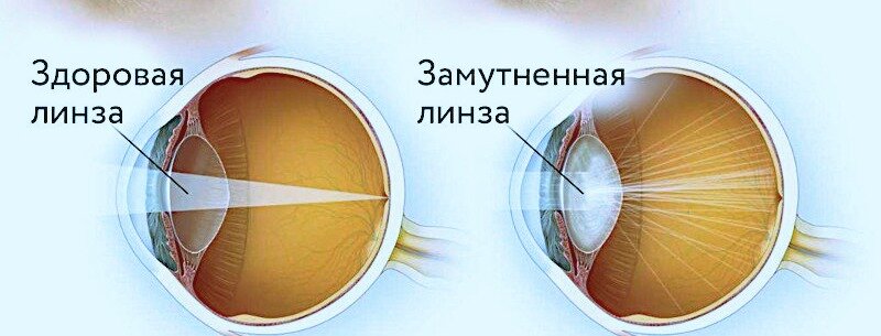 сравнение здорового и мутного 