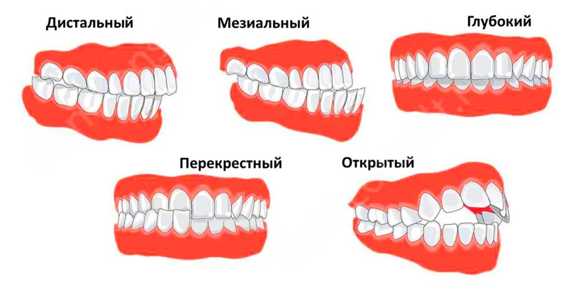 Правильный прикус у человека