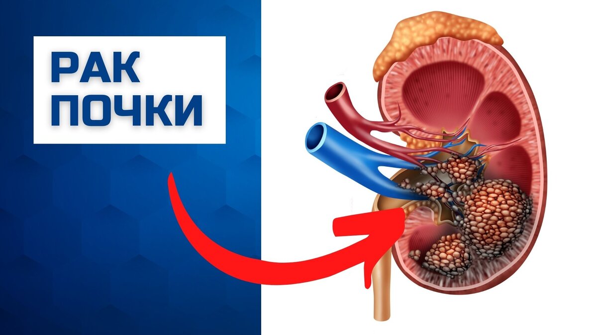 Опухоль почки в 80% случаев - почечно-клеточный рак