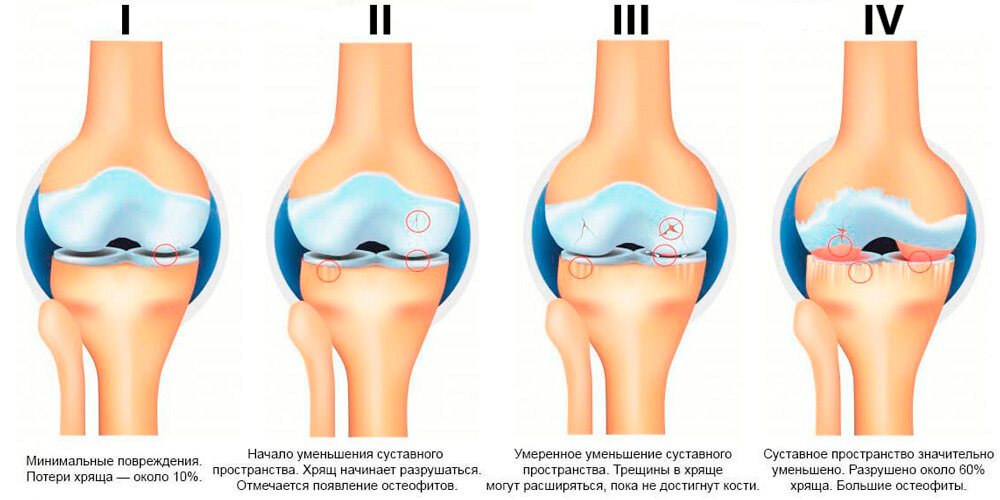 Артроз коленного сустава схема. Посттравматический гонартроз коленного сустава 2ст.. Гонартроз и остеоартроз различия. Разница между артритом и артрозом коленного.