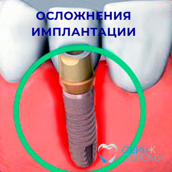 Осложнения имплантации зубов / Обзор стоматолога центра имплантации зубов «Один к Одному» в Перми