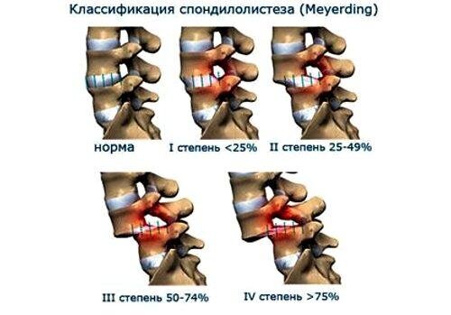 Ретролистез l5 позвонка рентген. Операция спондилолистез поясничного. Спондилолистез крестцового. Спондилолистез крестцового. Спондилолистез крестцового.