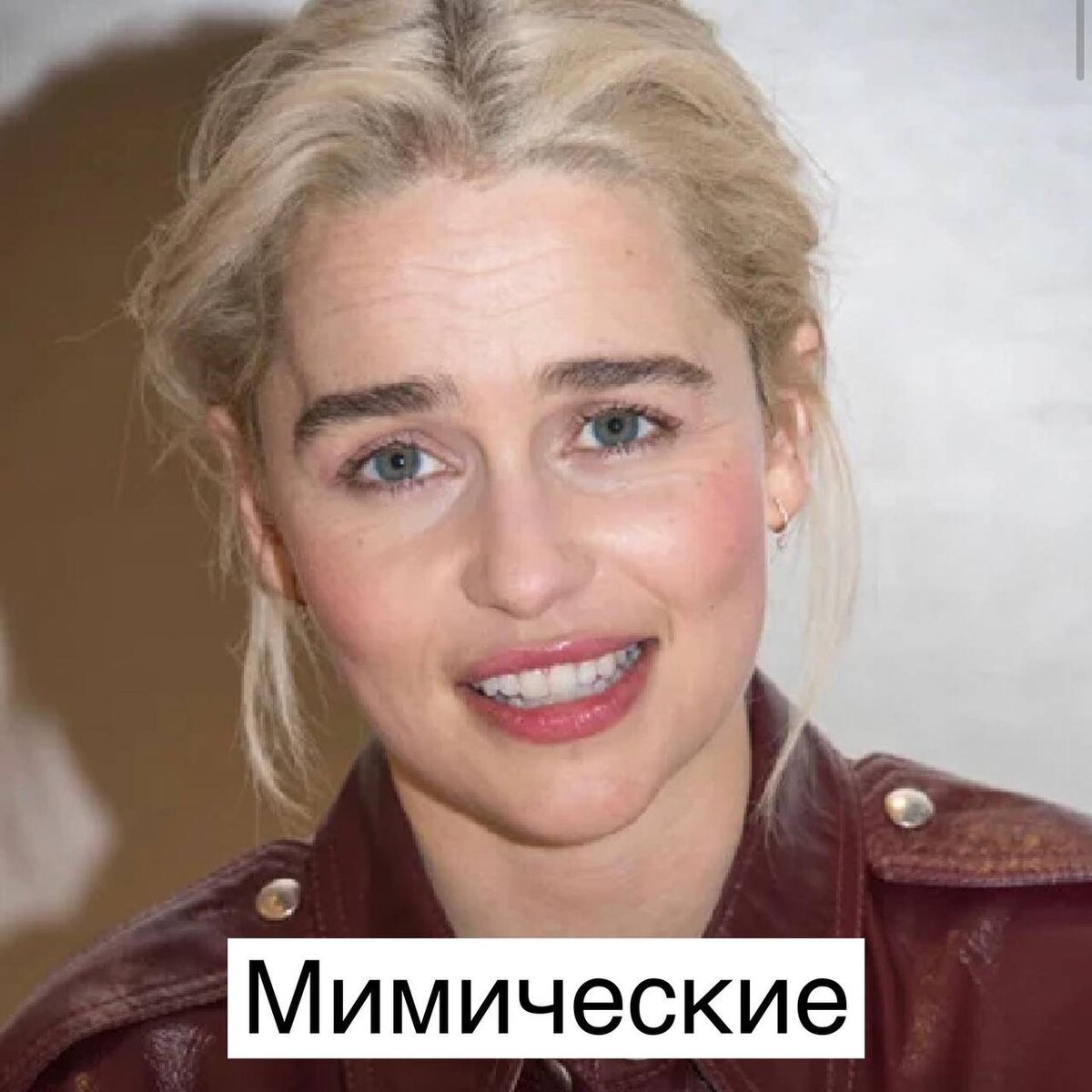 1. Мимические - проблемы сформированные, в результате активной мимики. К ним обычно относятся морщины на лбу и межбровье. 