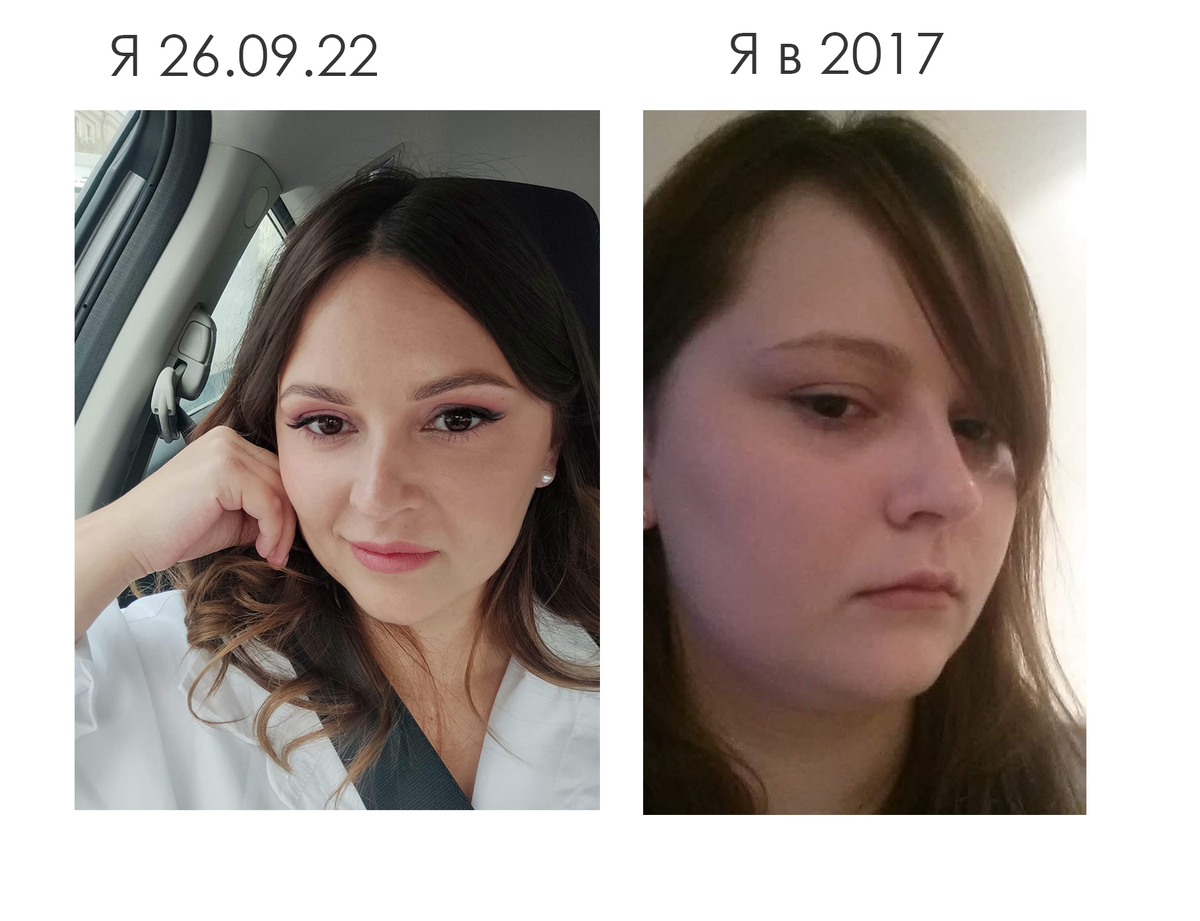 Скажете разница в весе? В 2017 году я весила 86 кг. Сейчас 93 кг. Это отдельная история. Но я лишь о том хочу сказать, что лицо поменялось не из за похудения. Девушки, кто хочет измениться и имеет избыточный вес, я помогу. 