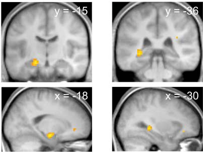 Активация структур мозга на МРТ при воздействии запаха во время сна