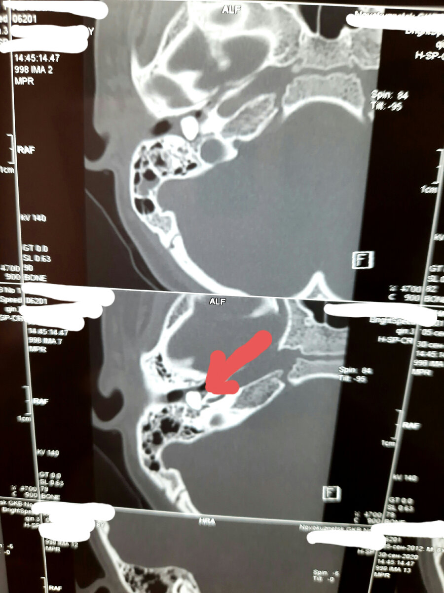 СКТ снимок височной кости. Стрелка указывает на камень.