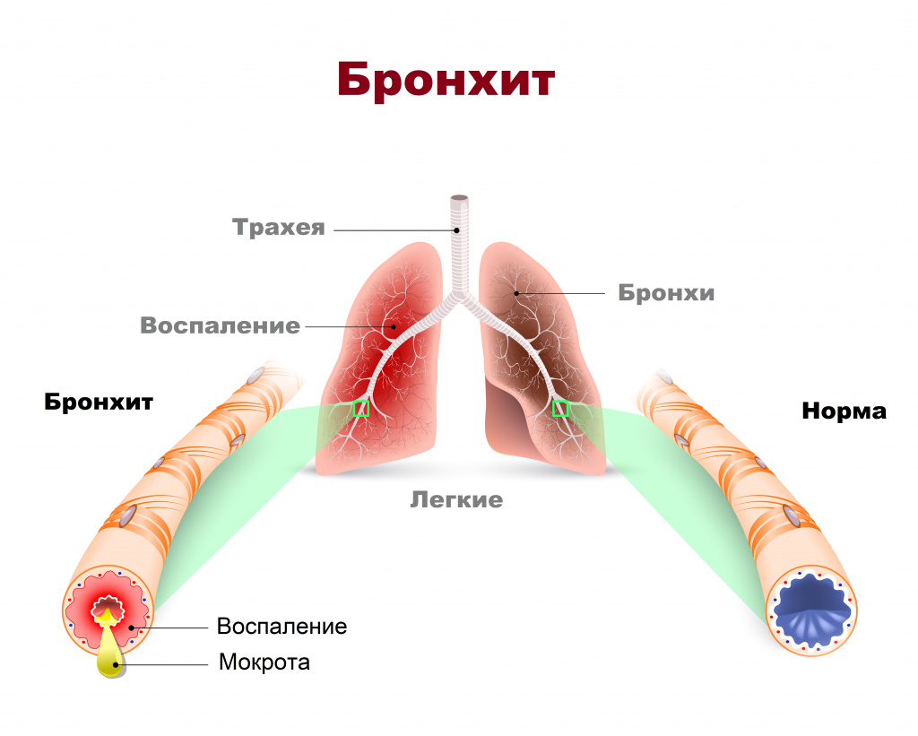 Бронхопневмония: лечение начинайте безотлагательно!