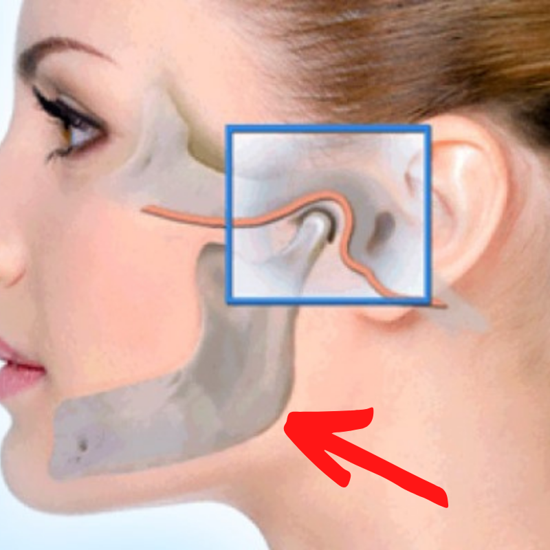 Угол нижней челюсти, где можно добраться до медиальной крыловидной мышцы