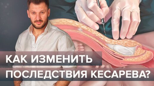 Кесарево сечение влияет на развитие ребенка! Чем отличаются дети-кесарята?