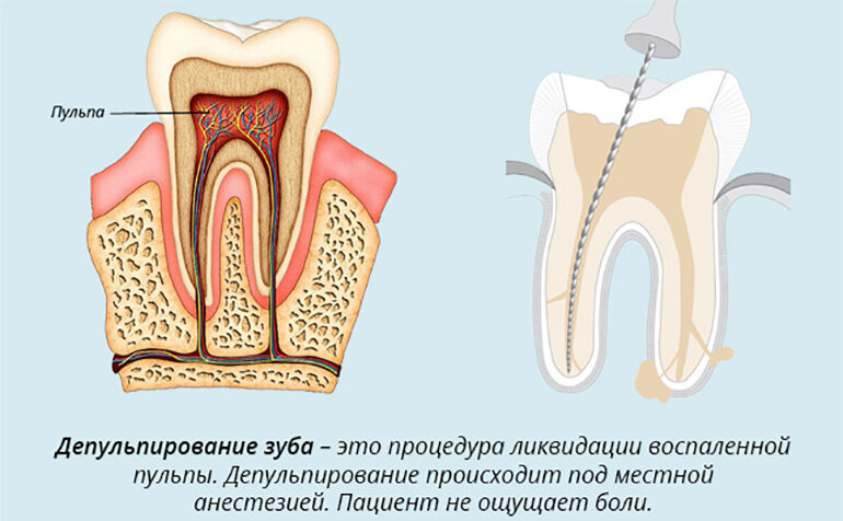 Удаление каналов в зубе