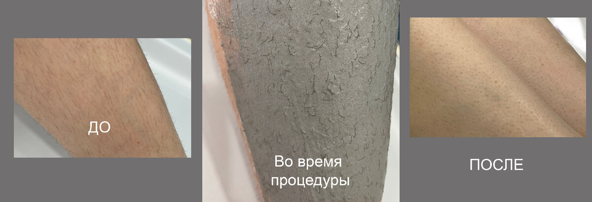 Фото до, вовремя и после процедуры на ногах.