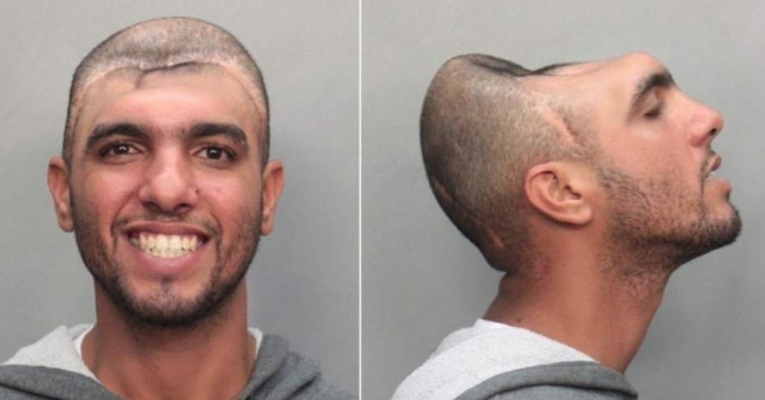 Карлос Родригес, потерял в аварии половину головы и нормально потом жил. Есть еще француз какой-то, у того не было 90% мозга от рождения, и жил нормальной жизнью.