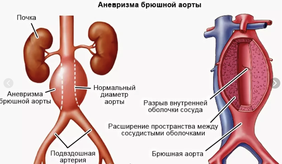 Как лечится аорта. Веретенообразная аневризма брюшной аорты. Патология брюшного отдела аорты. Аневризма брюшной аорты симптомы. Аневризма брюшной аорты схема.