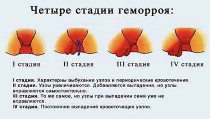 Трещина в заднем проходе фото - Фотобанк Fotodao.ru