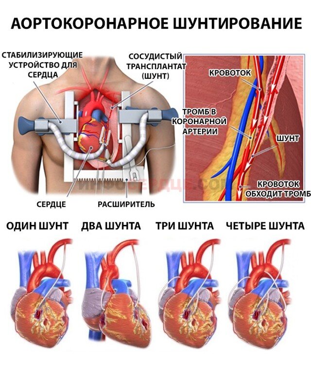 Шунтирование сосудов сердца стент. Схема операции аортокоронарного шунтирования. Операция аорто коронарного шунтирования. Операция шунтирование сердца инфаркт.