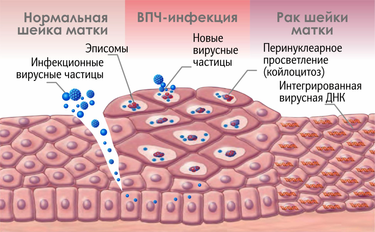 ВИУС папиломы человека. Вирус папилломы человека (ВПЧ).