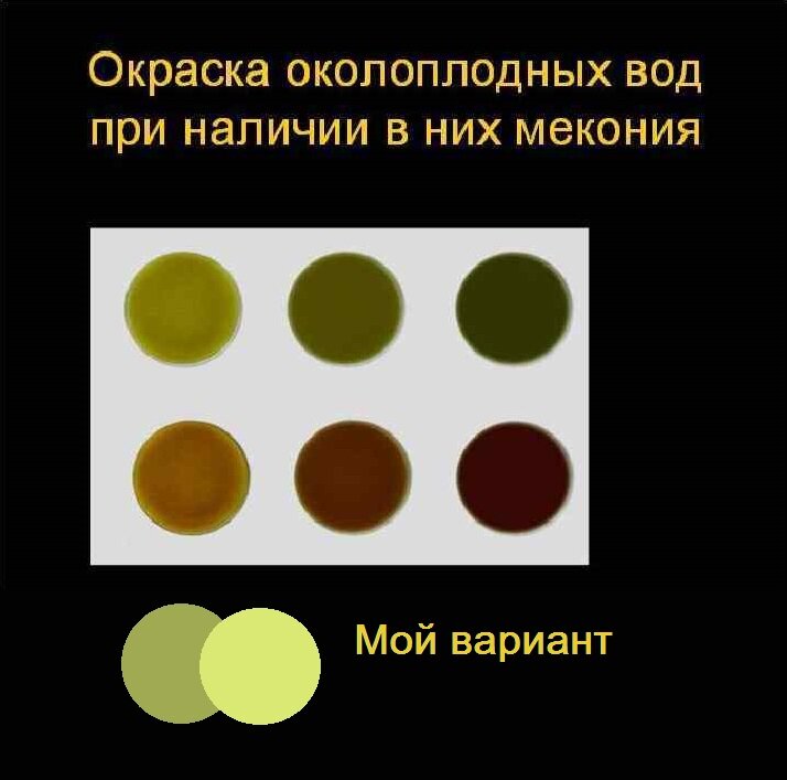 Воды у беременных: когда отходят и что нужно делать 🌺 – Юнона