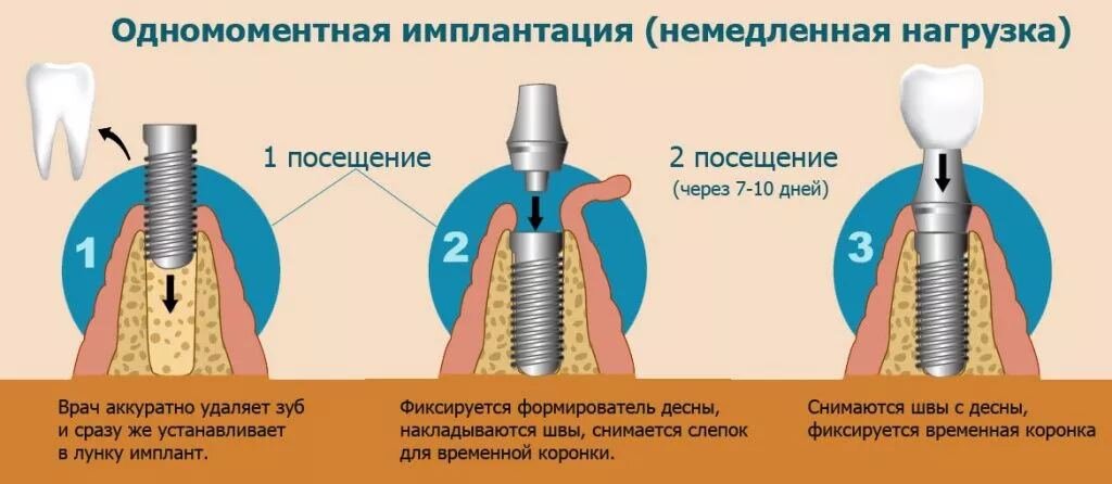 Имплантации доктора федорова. Двухэтапная методика имплантации. Двухэтапная методика имплантации зубов. Двухэтапная имплантация зубов этапы. Этапы имплантации зуба абатмент.