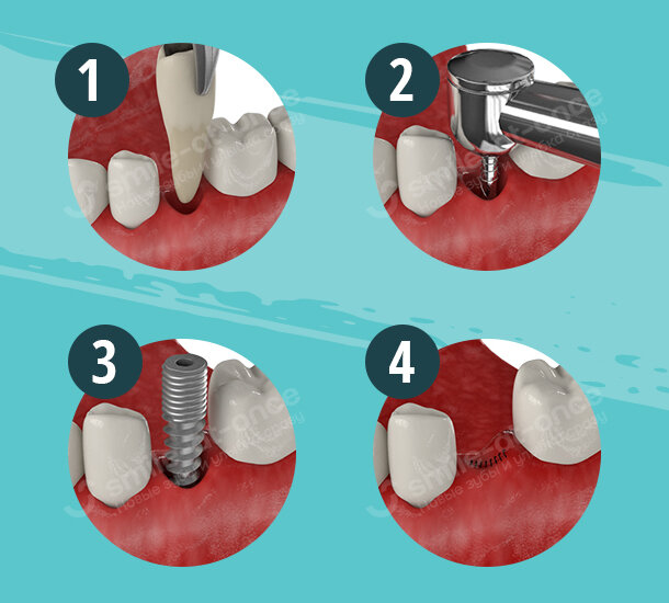 Можно ли ставить имплант после удаления