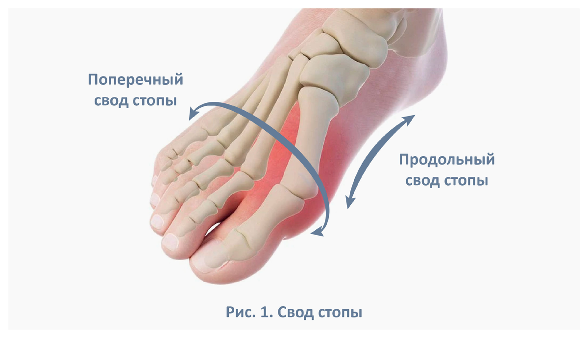 Деформация свода стопы