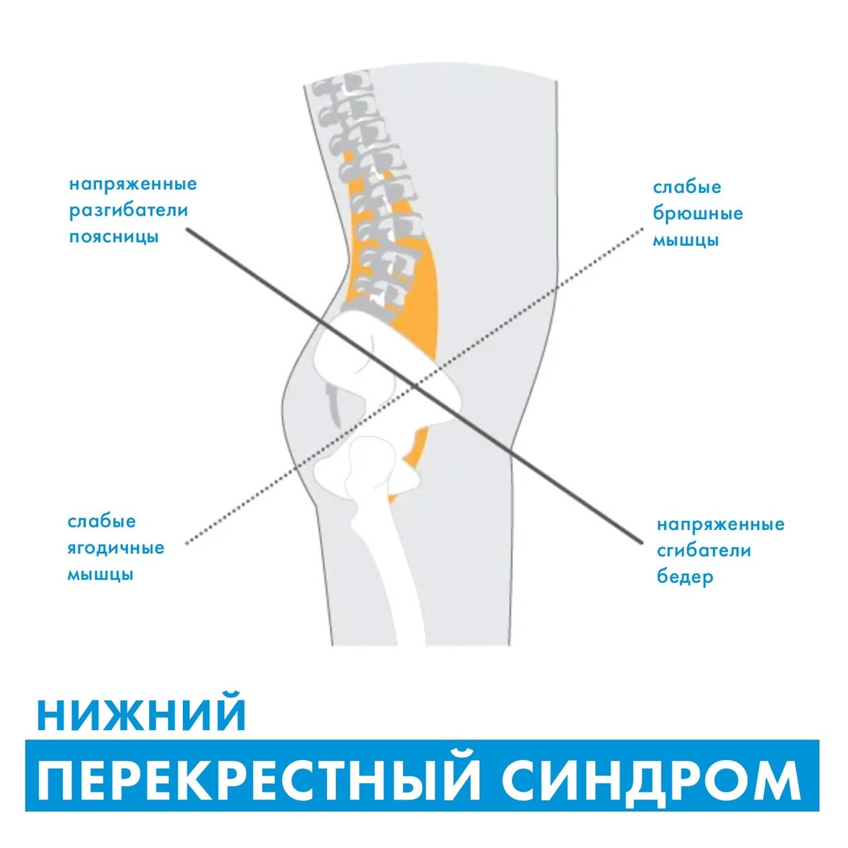 Нижний перекрестный синдром