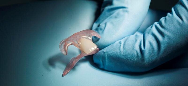 Временный зубной протез