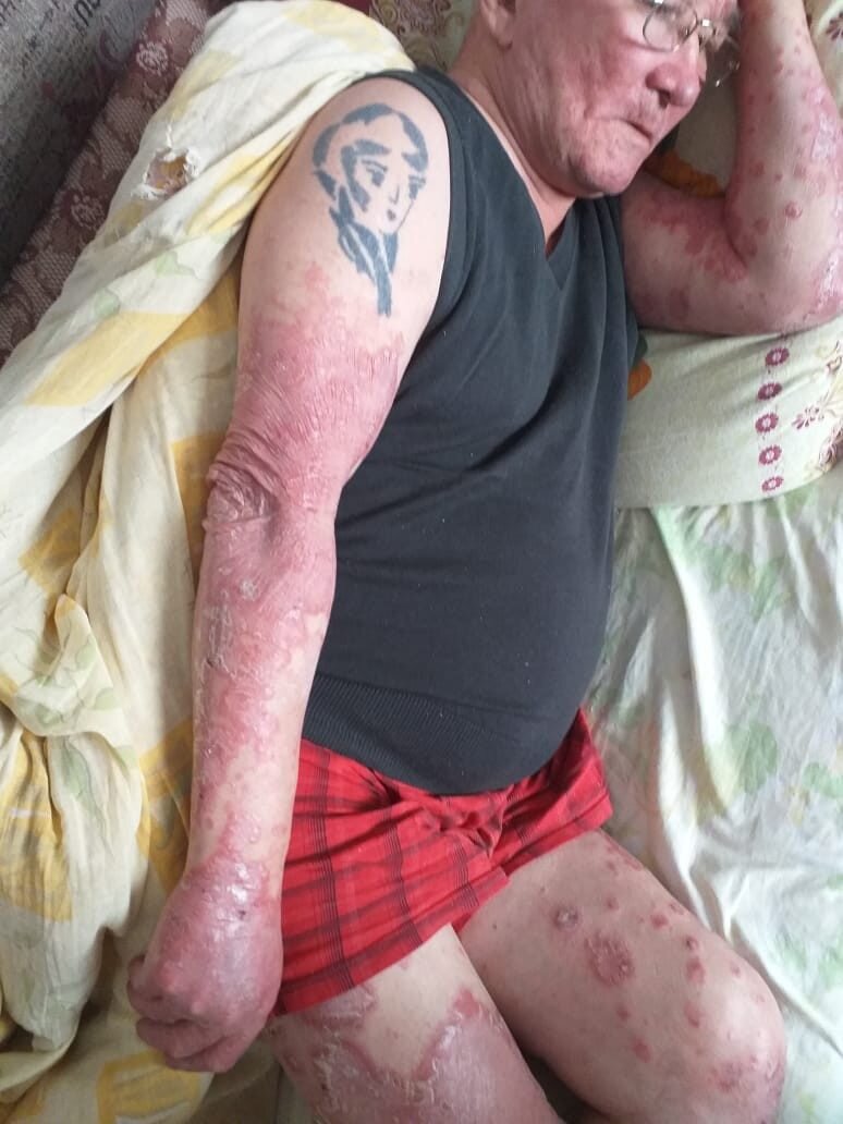 Хочу поделиться результатом по псориазу у моего отца Хасанов Амиргалеей (1952г.р.), 25 февраля 2019г  он начал принимать бальзамы компании Global Trend Perfecto Lux и Vitality Lux, но с начало не большое предисловие. О существовании нано бальзамов узнала моя сестренка Салима, в последствии заказав их для родителей. Отец конечно же обозвал их БАДами, аргументировав, что к его годам ни что ему уже не поможет, и что псориаз не излечим и т.д., но в итоге согласился их принимать, вот две фотографии до приема нано бальзамов