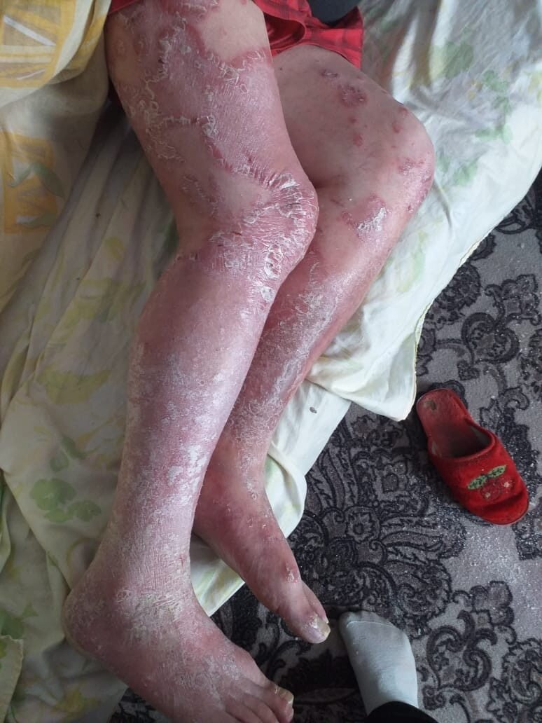 Поверьте в живую было на много страшнее это видеть,  в добавок у него было сильное варикозное расширение вен, нарушение кровотока в районе голени, терялась чувствительность ног, хотя в ноябре 2018 г он был на консультации у сосудистого хирурга в Челябинске, далее аптека, лекарства и ни ко кого результата, только прогноз хирурга, что если не лечить назначенными лекарствами, то может привести к гангрене, далее ампутация. В итоге не дешевые лекарства ощутимой пользы не дали, может по этому сестра решилась заказать бальзамы, и как оказалось не прогадала, хотя я тоже по началу к ним отнесся с большим  не доверием.
В итоге отец пропил один курс (месяц), то есть два бальзама Perfecto Lux и Vitality Lux, а результат просто чудо какое то!!!