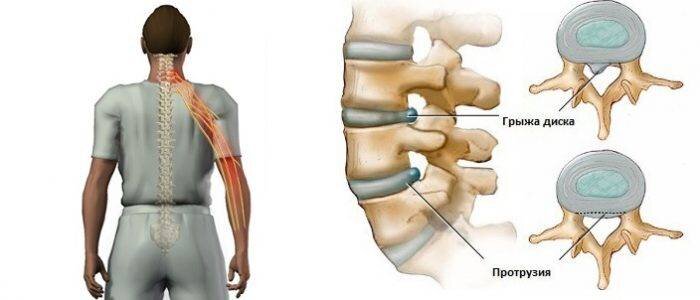 Грыжа диска и протрузия. Фото из открытых источников