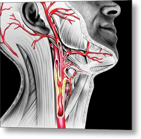 Холестериновые бляшки в сосудах шеи | От чистого сердца ️ Ваш ...