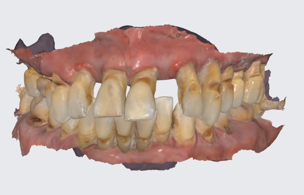 Хронический генерализованный пародонтит тяжёлой степени тяжести. Пациент 1.