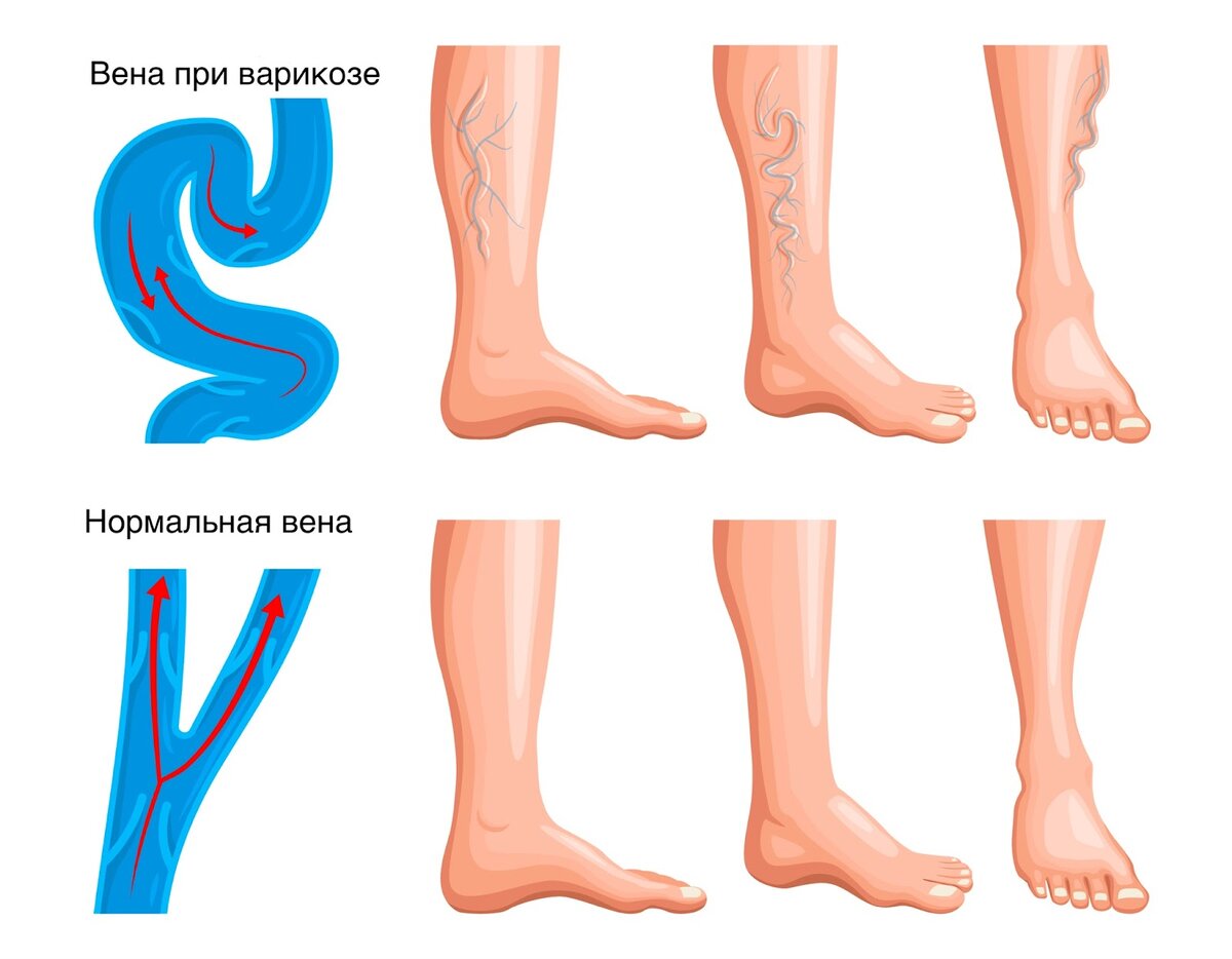 Варикоз на ногах. Причины и симптомы заболевания | Здоровье с B.Well | Дзен