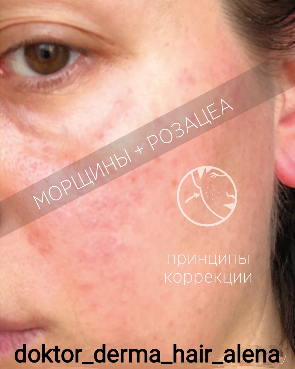 #омоложениекожи 
