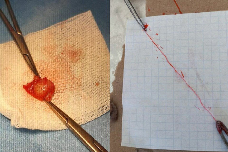    15-сантиметрового червя достали из мошонки у подростка в Нижнем Новгороде. Фото: НОДКБ