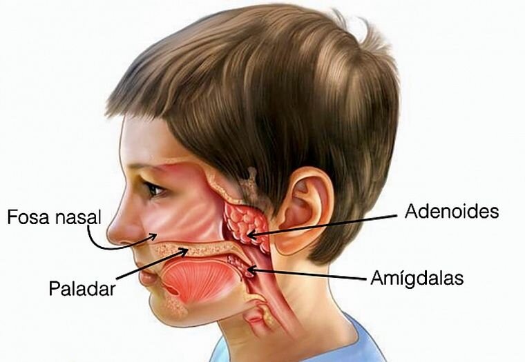 Аденоиды у ребенка: симптомы и лечение