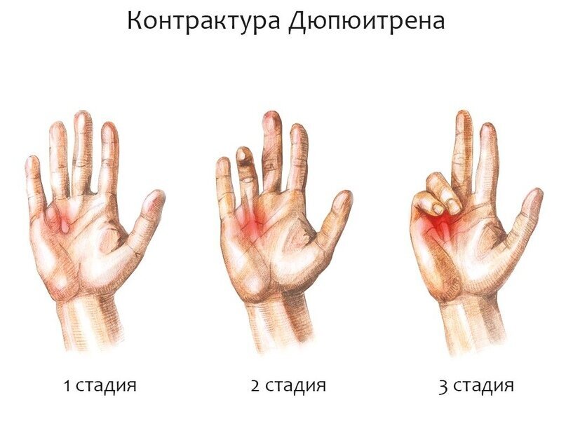 Контрактура Дюпюитрена 