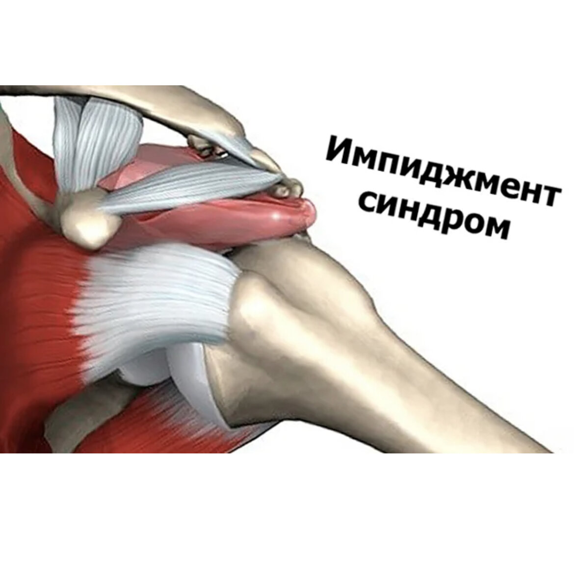 Импиджмент синдром надостной мышцы. Вращательная манжета плеча. Субакромиальный импинджмент-синдром плечевого сустава мрт. Субакромиальный импинджмент-синдром плечевого сустава. Синдром плечевой манжеты.