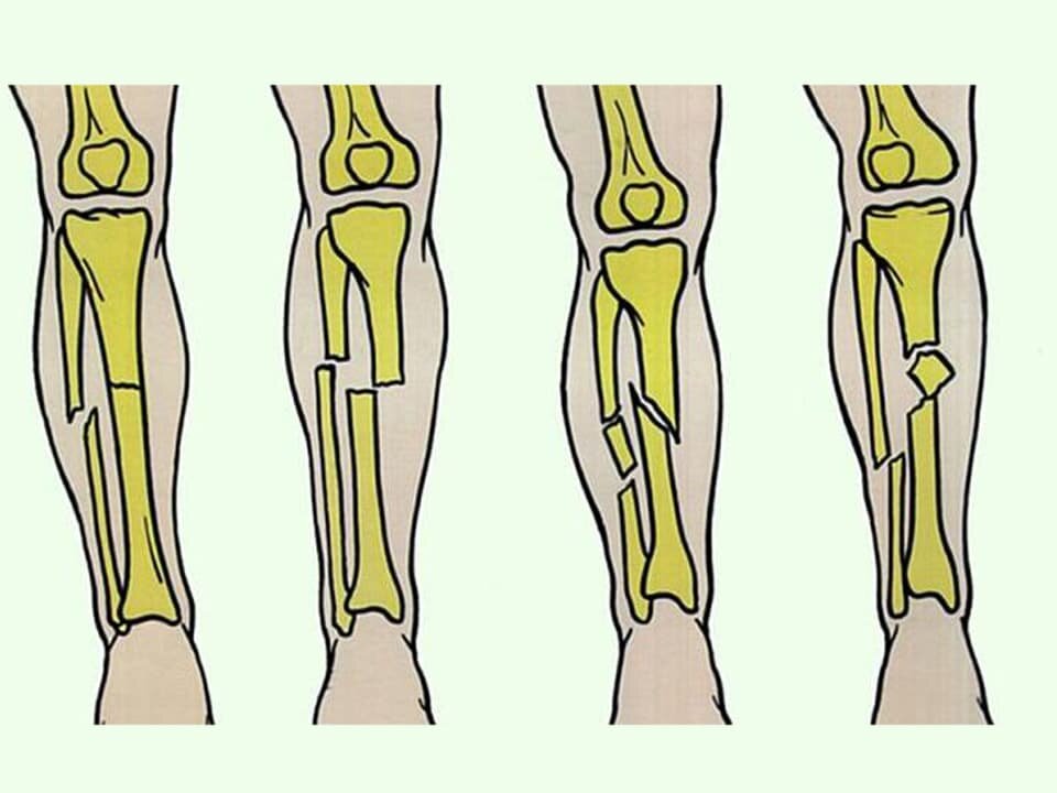 Перелом костей человека. Диафизарный перелом большеберцовой кости. Диафизарные переломы костей голени. Классификация диафизарных переломов костей голени. Классификация переломов диафиза голени.