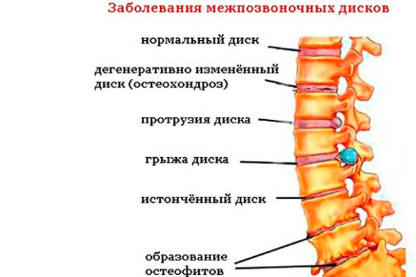 Остеохондроз поясничного отдела позвоночника. Заболевания межпозвонковых дисков. Патология межпозвоночных дисков. Нарушение межпозвоночный дисков. Поражение межпозвонковых дисков.