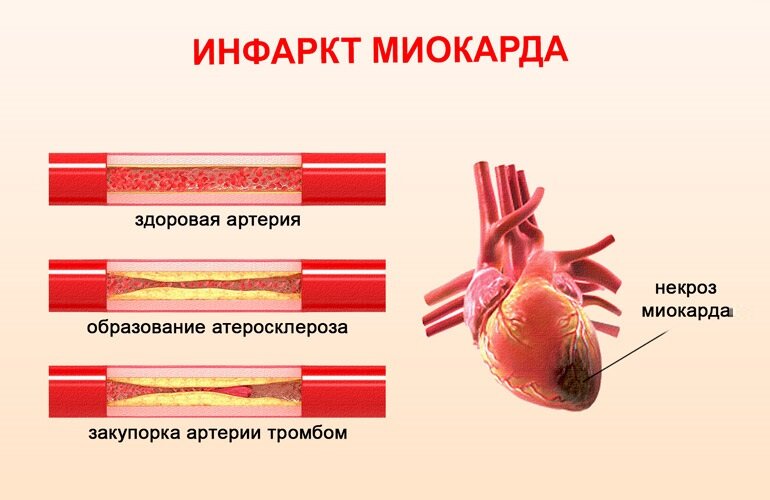 У меня был обширный инфаркт как это влияет на пенсию