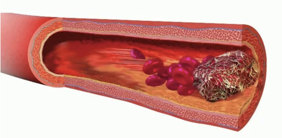 Тромбофлебит артерий. Тромбоз кровеносных сосудов. Тромбоз и эмболия и атеросклероз. Эмболия это закупорка кровеносных сосудов.