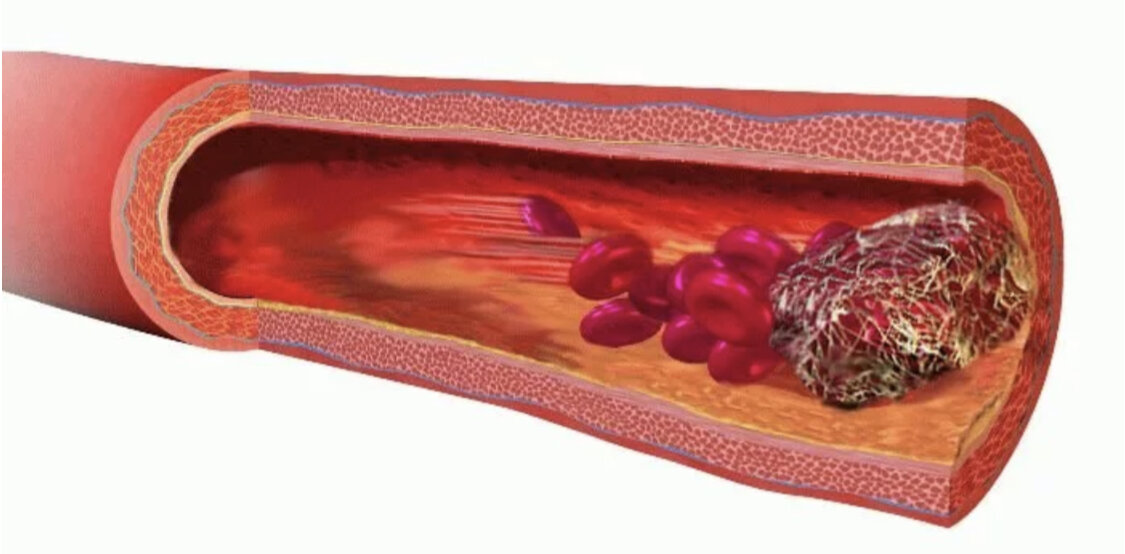 Кровяной тромб. Тромбоз кровеносных сосудов. Тромбоз и эмболия и атеросклероз. Эмболия это закупорка кровеносных сосудов.