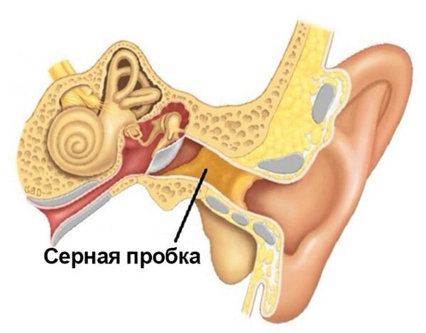 Серные пробки: причины, лечение, профилактика