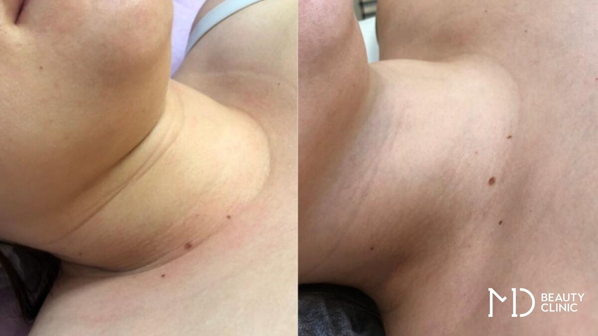  Лазерное омоложение шеи