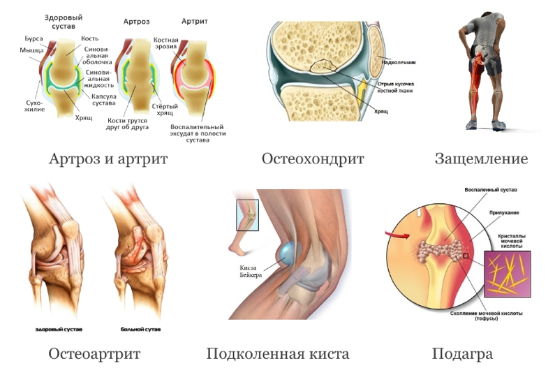 Сильно болят кости. Заболевание коленного сустава диагноз. Воспаление коленного сустава диагноз. Заболевач коленного сустава. Заболевания суставов коленей.