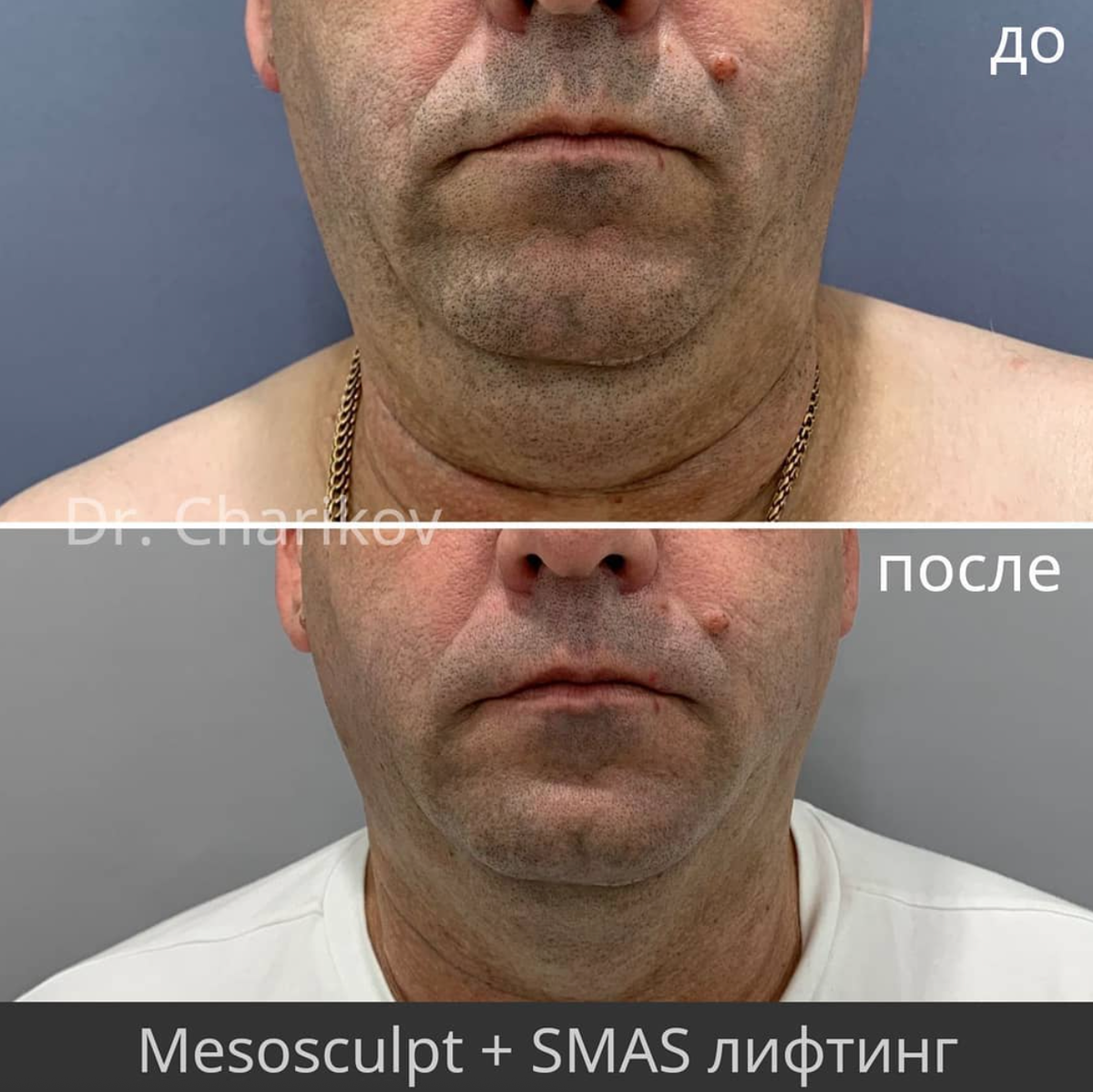 Работа врача Чарикова Вадима Андреевича (клиника Dr. ЭСТЕТИК)